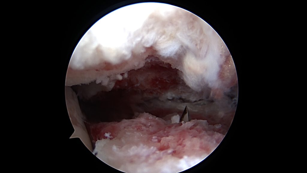 Repozycja złamania kostki przyśrodkowej.